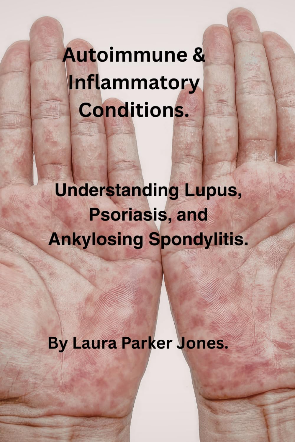 Autoimmune & Inflammatory Conditions.: Understanding Lupus, Psoriasis, & Ankylosing Spondylitis. (Arthritis and You)