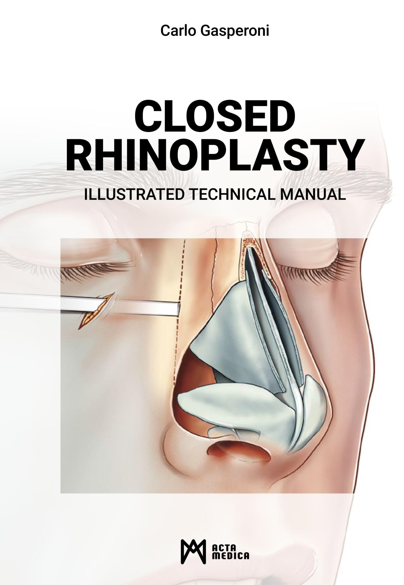Closed rhinoplasty. Illustrated technical manual