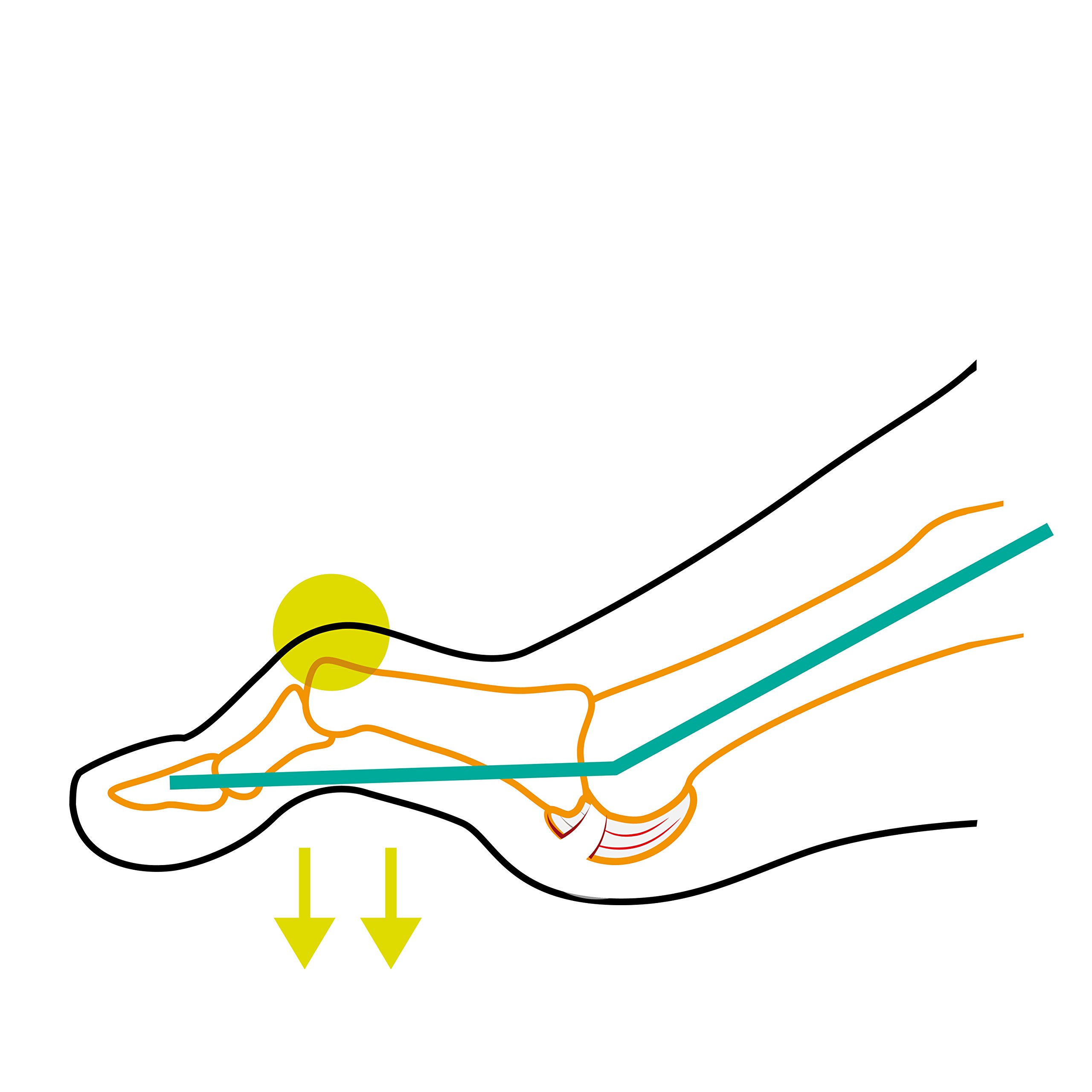 COMPRESSANA TAPE SOX - Hammerzeh Korrektur-Socken mit eingearbeiteten Tapes für den zweiten Zeh - wirksam bei Hammerzehe, Krallenzeh, hallux malleus, digitus malleus - 1 Paar