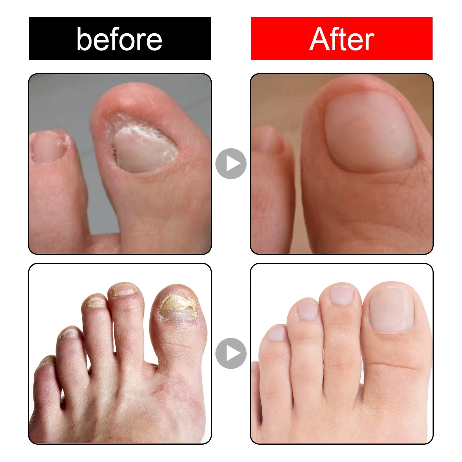 HIVETZ Ingrown Toenail Treatment,Nail Helper,Nail Growth Treatment,Ingrown Toenail Drops,Cuticle Nail Oil,Ingrown Toenail Correction,Fungal Nail Treatment for Toenails Extra Strong for Damaged Nails - Image 3