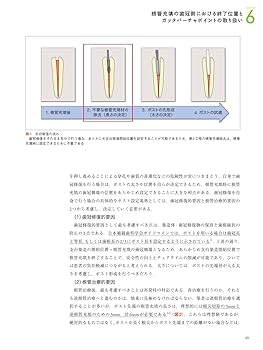 根管充填 | 吉岡 隆知, 吉岡 俊彦, 八幡 祥生, 橋本 健太郎, 興