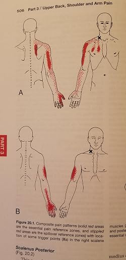 32+ Travell And Simons Trigger Point Chart