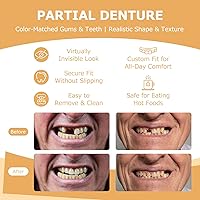 Vista 4 de Prótesis parciales – Dentaduras postizas para dientes perdidos y huecos – Dientes de repuesto ligeros e irrompibles para hombres y mujeres