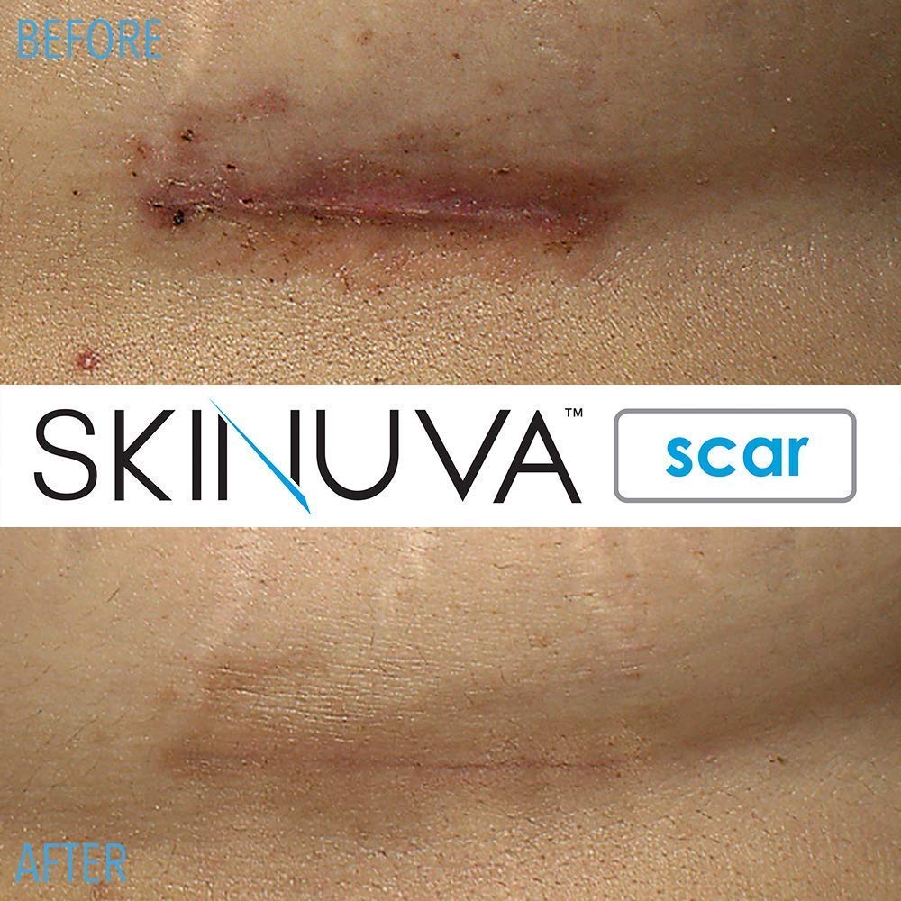 Skinuva® Next Generation Scar Cream - Advanced Scar Cream Formulated with Growth Factors (1 oz) - Image 6