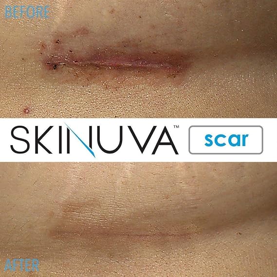 Skinuva Scar Cream for Face & Body (1 oz) | Helps Fade the Appearance of Old & New Scars, Treatment for Surgery, Burns & Other Skin Trauma, For Medium Scars