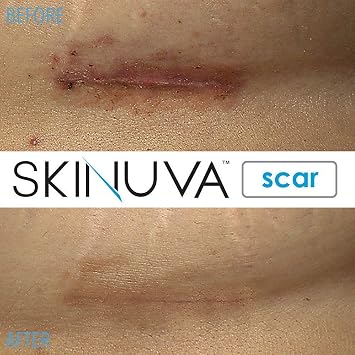 Skinuva Scar Cream for Face & Body (1 oz) | Helps Fade the Appearance of Old & New Scars, Treatment for Surgery, Burns & Other Skin Trauma, For Medium Scars