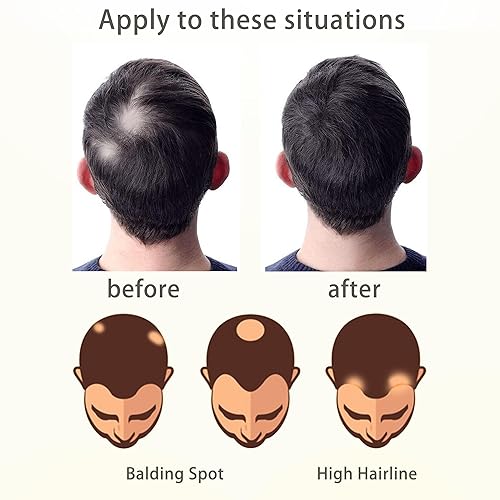 Miniatura 8 de Reemplazo de cabello humano con cicatrices, quemaduras accidentales sin vello para hombres y mujeres, pérdida de línea de cabello, cinta recta de