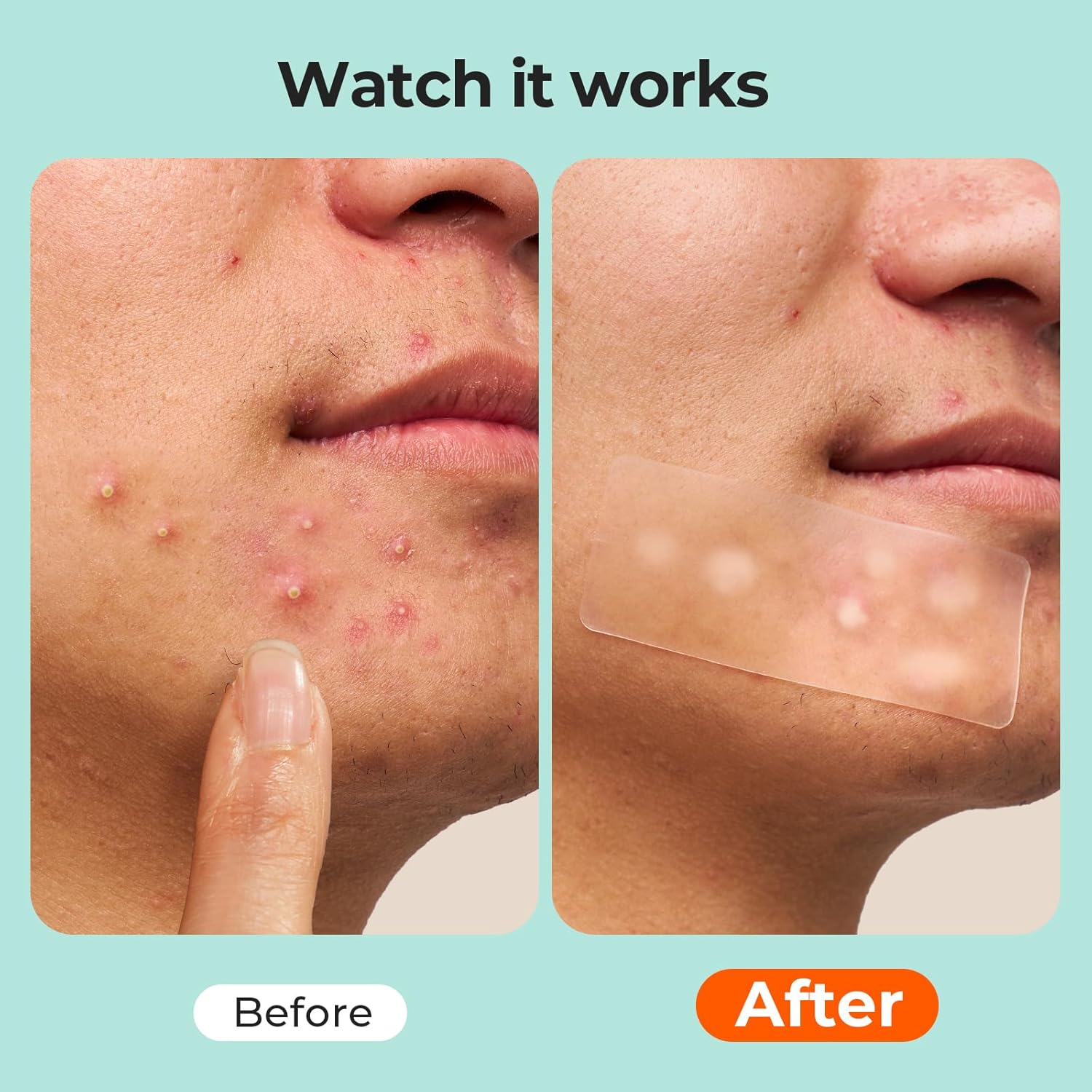 TKTK 2-Size Hydrocolloid Roll, Hydrocolloid Bandages, Hydrocolloid Patch for Acne, Wound, Burn, Blister Care, Pimple Patches with Easy-Peel Backing, Waterproof & Ultra Absorbent - Image 3