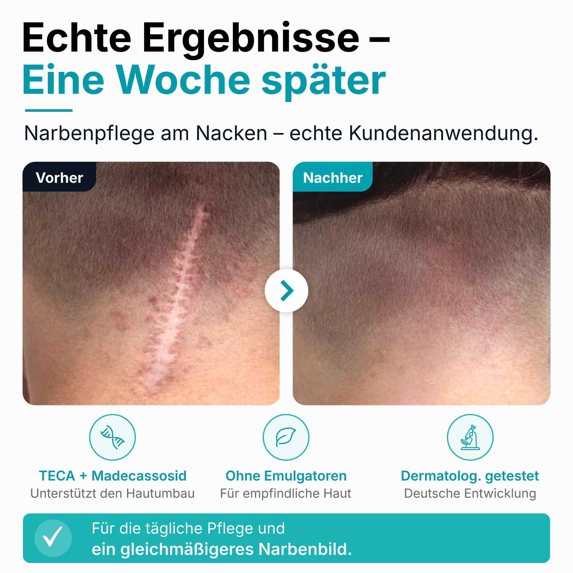 Krem do pielęgnacji blizn – regenerująca pielęgnacja świeżych i dojrzałych blizn | z madecassozydem, kwasem hialuronowym i ektoiną | do wszystkich rodzajów skóry | bez perfum, silikonów i