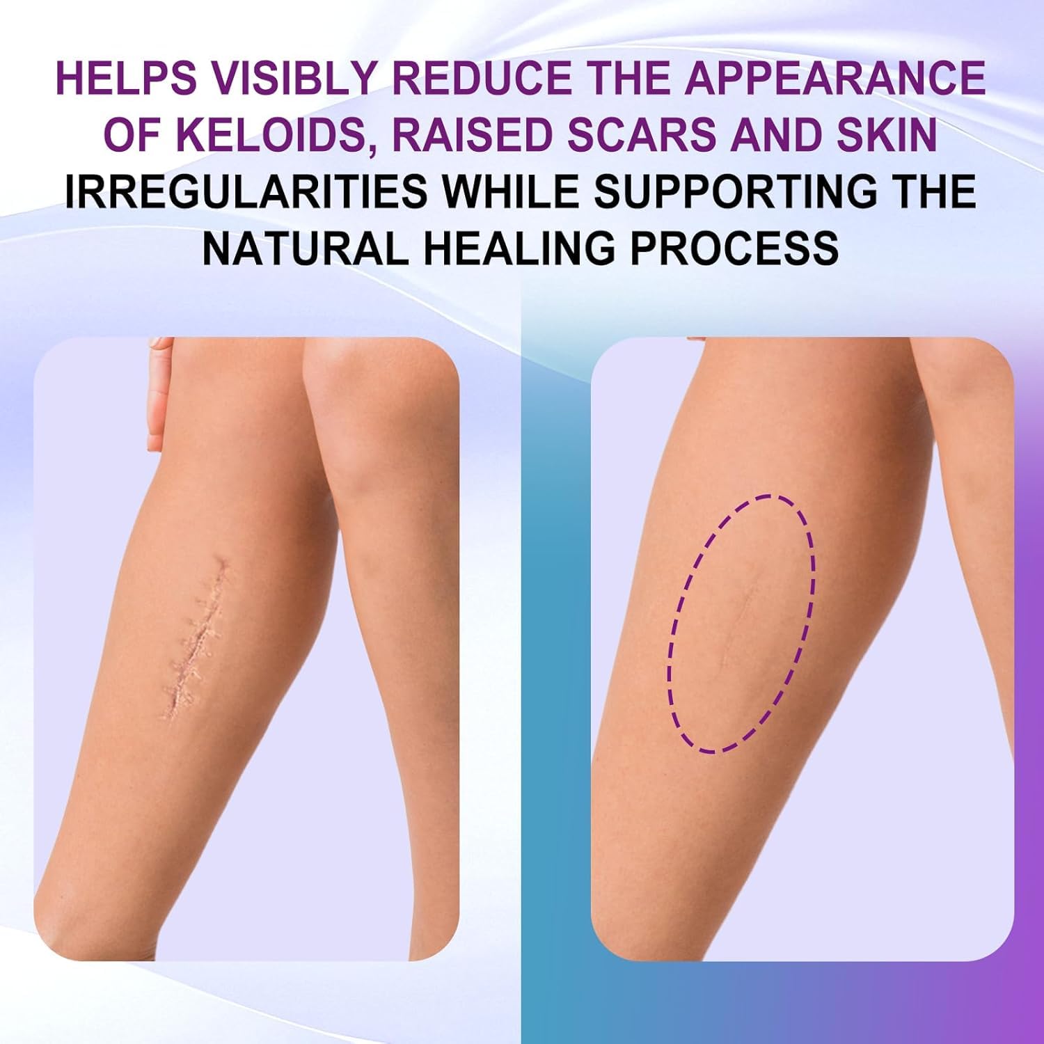 Silicone Scar Gel, Intensive Scar Cream, 2.1oz Keloid Bump Removal for Stretch Marks Removal, Surgical Scars, Cesarean Section, Acne, Injury, Burns, Doctor-tested Scar Improvement (60g) - Image 3