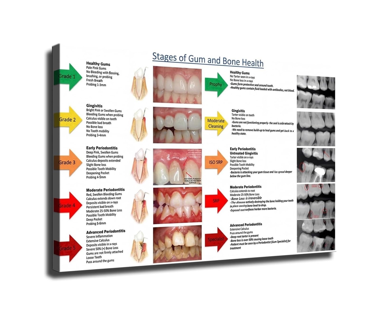 MQXFCZUX Periodontitis Infographic Poster Gum Health Care Guide Wall-Art Decor For Hygienist Clinic Office
