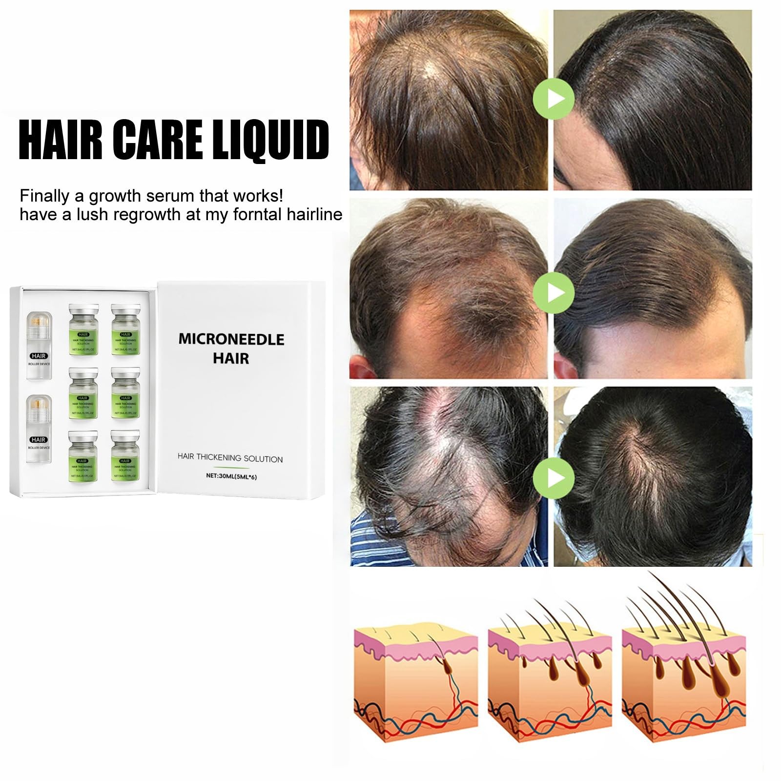 Hair Regrowth System, New Hair Growth Serum & Regrowth Treatment for Women & Men, Micro-Needling Infusion Scalp Serum - Image 2