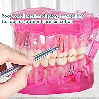 Vista 5 de Modelo de dientes de implante dental transparente - Modelo de dientes de enfermedad transparente Modelo de dientes patológicos con dientes