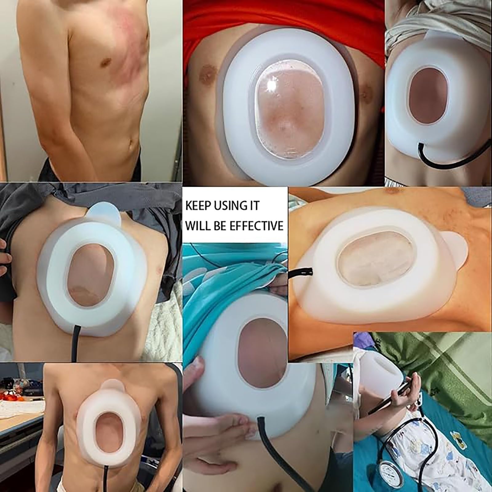 Dzwon próżniowy Klatka piersiowa lejkowata, sprzęt rehabilitacyjny Ortopedyczna klatka piersiowa, dla wszystkich grup wiekowych (L)