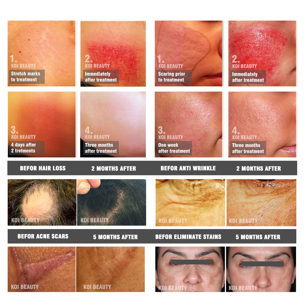 Koi Beauty Professional Microneedling Derma Roller Real Individual 192Pins Titanium Dermaroller For Face Hair Beard Growth - Protective Storage Case : Health & Household