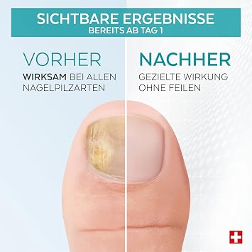 -Plant-based Powerful Antifungal Repairing Purifying and Revitalizing Treatment for Nails Professional Hand/Foot care.Quick & Easy. Made in Switzerland.