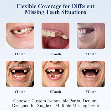 Custom Partial Dentures for Missing Teeth (1 Tooth)