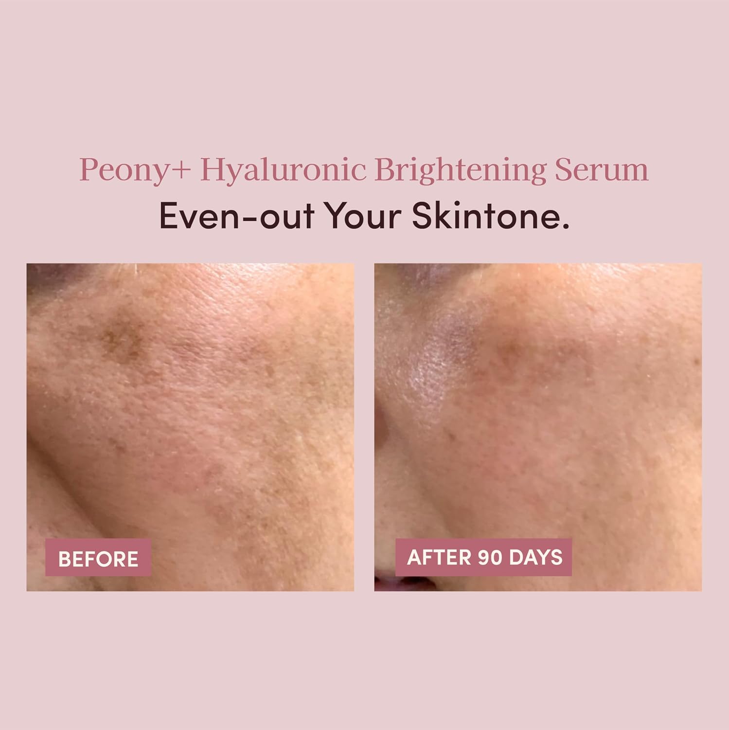Pretti5 Tranexamic Acid & Niacinamide Brightening Serum – Peony Dark Spot Corrector for Sensitive Skin – Fades Hyperpigmentation & Acne Marks – Made in Japan TCM Vegan Skincare – 30ml