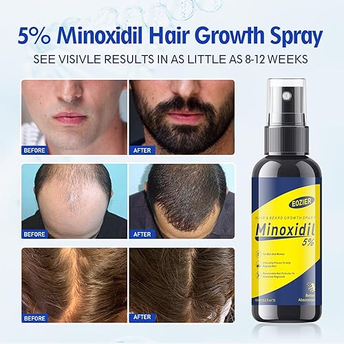 Miniatura 3 de 5% de minoxidil con biotina, tratamientos de pérdida de cabello para mujeres y hombres, tratamiento de regeneración del cabello, aceite de suero de
