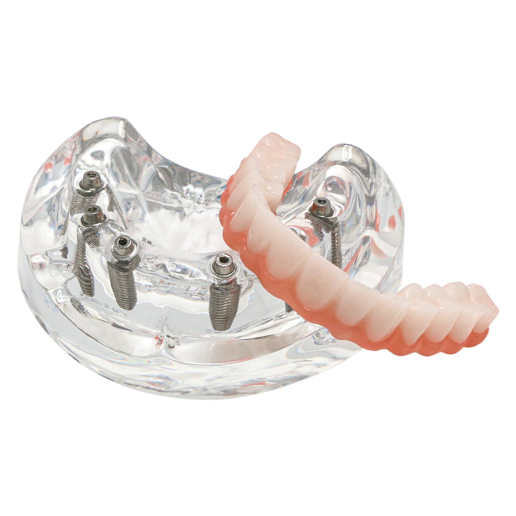 Dental Implant Teaching Model, Upper Jaw with 6 Implant Posts and Prosthetic Bridge, Clear Base