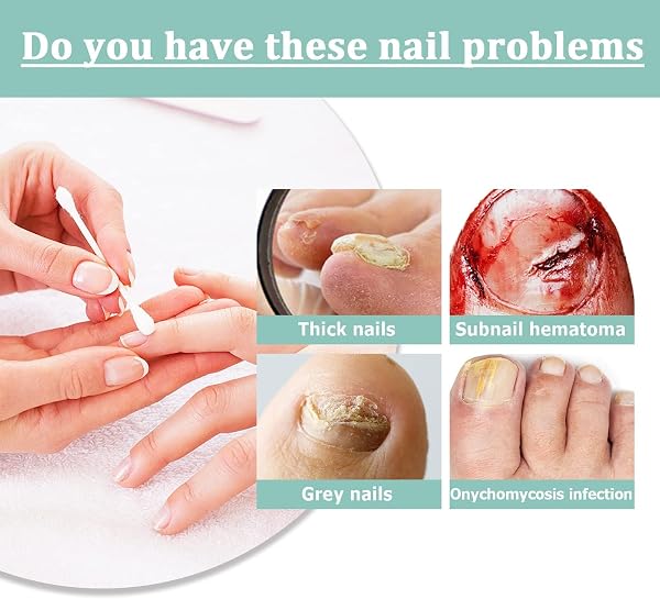 Orvielle Ongles Anti Fungal Pen(1PCS) - 1