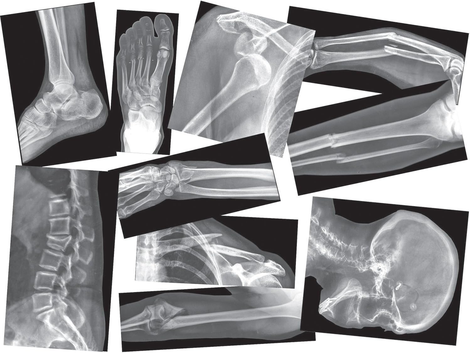 Roylco Broken Bones X-Ray Set, Projector Display Compatible, 15 X-Rays