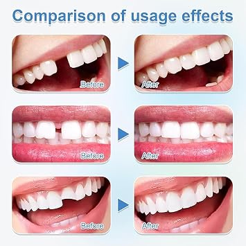 2 Pcs Temporary Tooth Filling Repair Kit, Moldable False Teeth, Tooth Filler for Fixing Broken