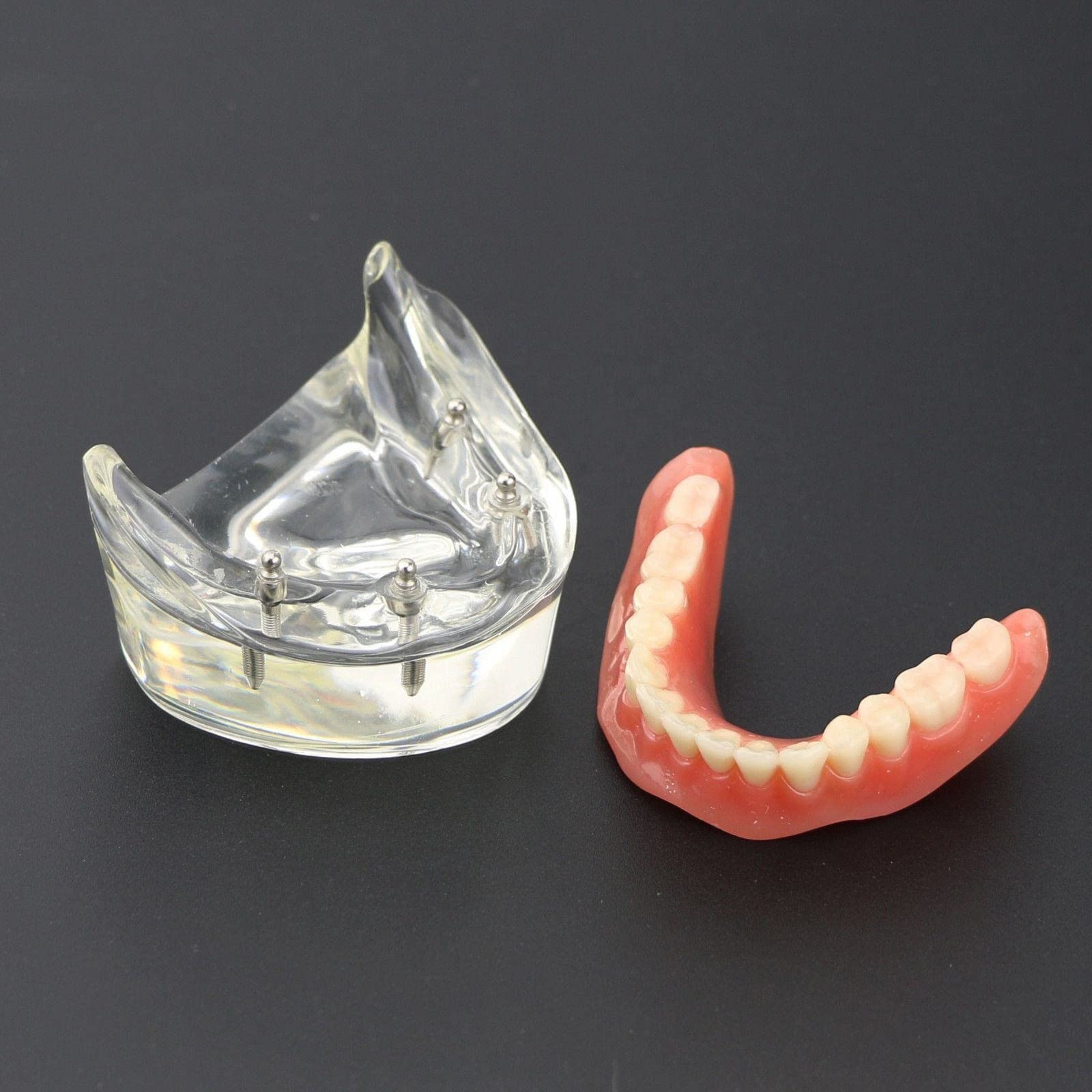 Modelo de sobredentadura Dental, modelo de dientes de enfermedad de implante, demostración de 2 implantes, para enseñar, estudiar, mostrar, comunicación con el paciente