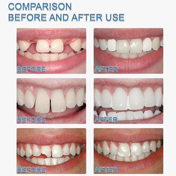 Temporary Tooth Repair Kit, 30ml Dental Filling for Cracked & Chipped Teeth, Quick Restoration & Shaping for Adults, Easy At-Home Use