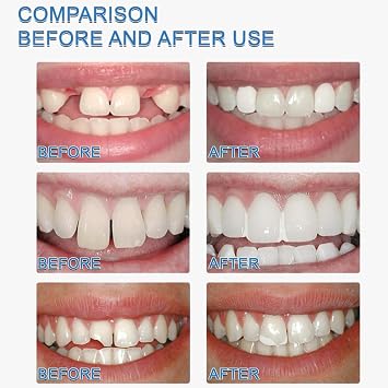 Temporary Tooth Repair Kit, 30ml Dental Filling for Cracked & Chipped Teeth, Quick Restoration & Shaping for Adults, Easy At-Home Use