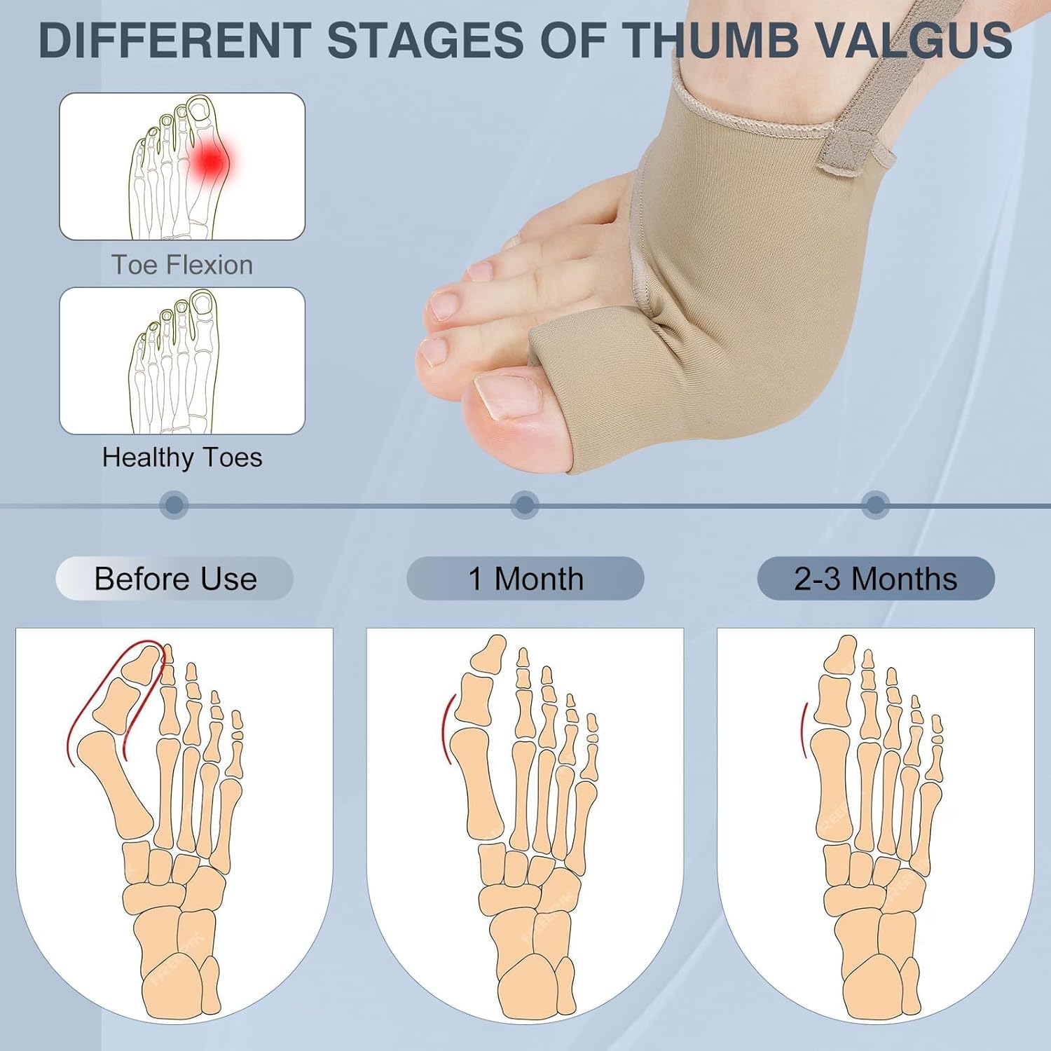 2PCS Bunion Corrector for Women & Men, Big Toe Straightener with Splint & Pads, Comfortable & Breathable for Day/Night Support, Hallux Valgus Pain Relief Non-Slip Socks (1, Beige)