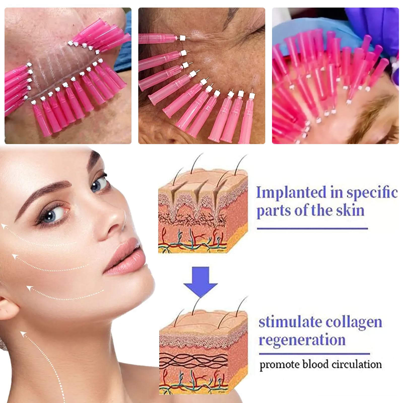 PDO Threads Mono Type Face Lift Whole Body Tightening 100pcs,26G-60MM 29G-38MM 29G-25MM Drei Größenoptionen (29G*38MM)