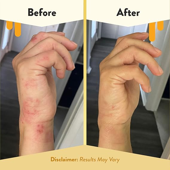 ECZEMA HONEY Antioxidant Body Oil, Sensitive Moisturizing Skin Oil (8 Oz) | Eczema-Prone After Shower All Over Body Oil Spray for Skin, Unscented Body Oils for Women, Men & Kids