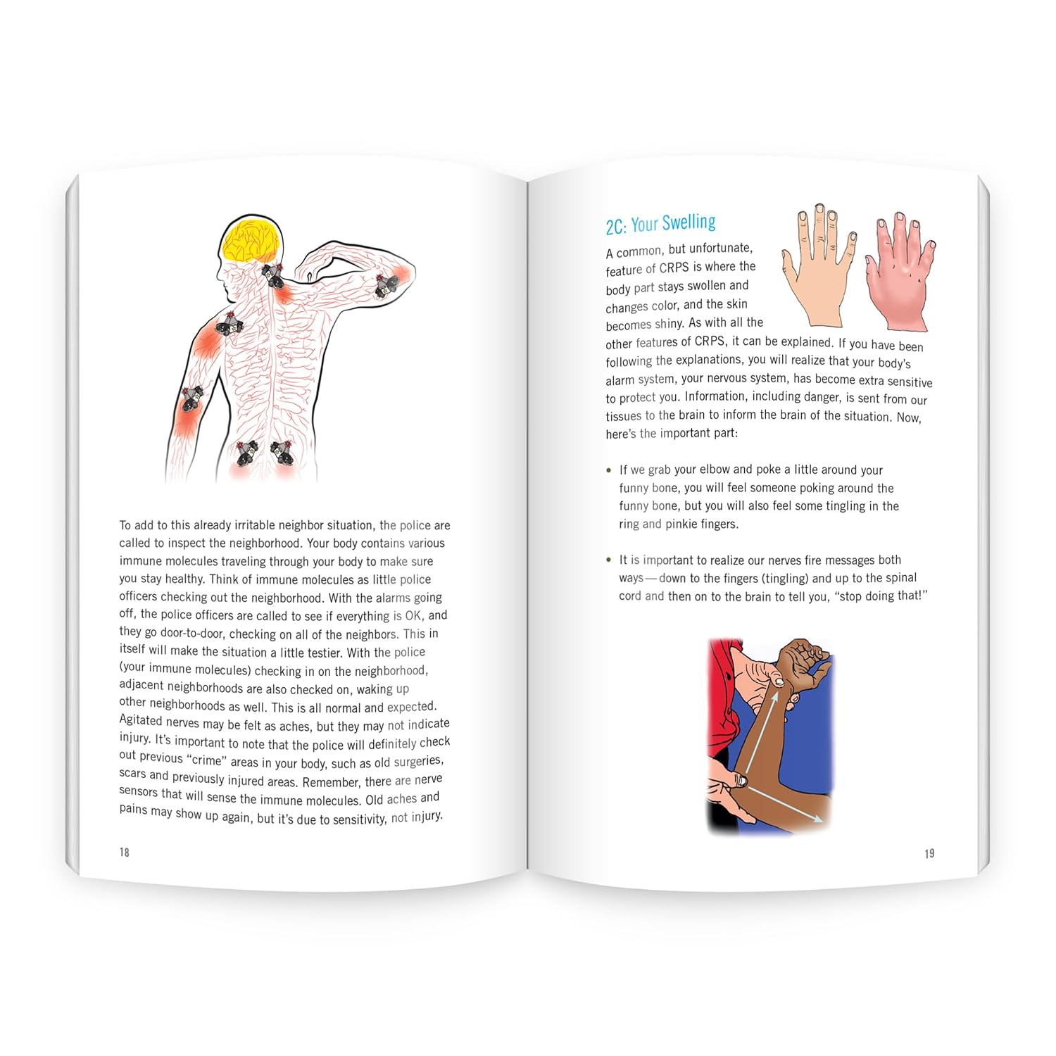 Why Are My Nerves So Sensitive?: Neuroscience Education for Patients with CRPS or RSD