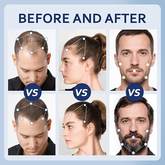 5% Minoxidil Hair Growth Serum for Men & Women with Biotin: Minoxidil for Men and Women, 5 Percent, Hair Regrowth Treatment, Extra Strength (12 FL OZ, Dropper 6)