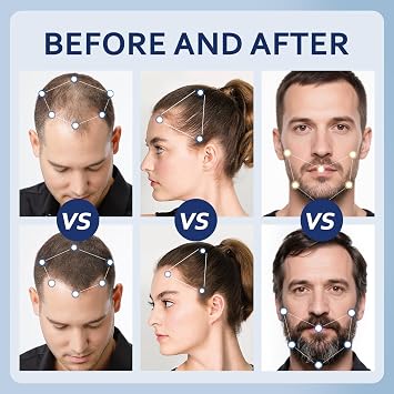 5% Minoxidil Hair Growth Serum for Men & Women with Biotin: Minoxidil for Men and Women, 5 Percent, Hair Regrowth Treatment, Extra Strength (12 FL OZ, Dropper 6)