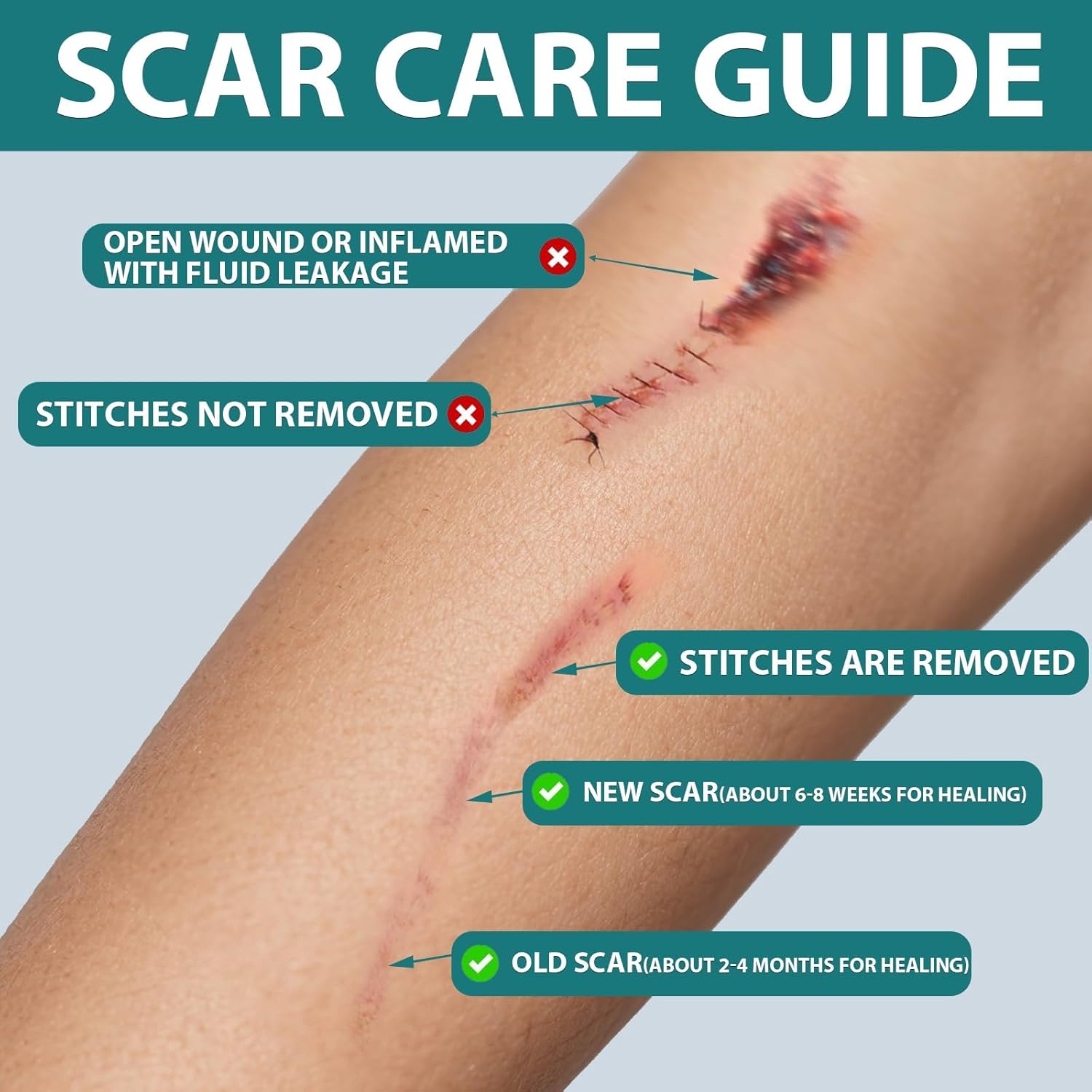 Silicone Scar Sheets,Silicone Scar Tape For Surgical Scars,Silicone Scar Removal Strips For Surgical,C-Section,Tummy Tuck, Keloid Scars Bump Removal (1.6"X 59" Roll-1.5M) - Image 3