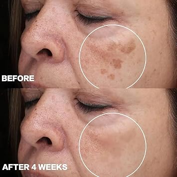 Age Spot Cream, Dark Spot Corrector for Face, Hands & Body, Helps Fade Age Spots, Sun Spots & Uneven Skin Tone, Fast-Absorbing, Non-Greasy, for All Skin Types (2pcs)