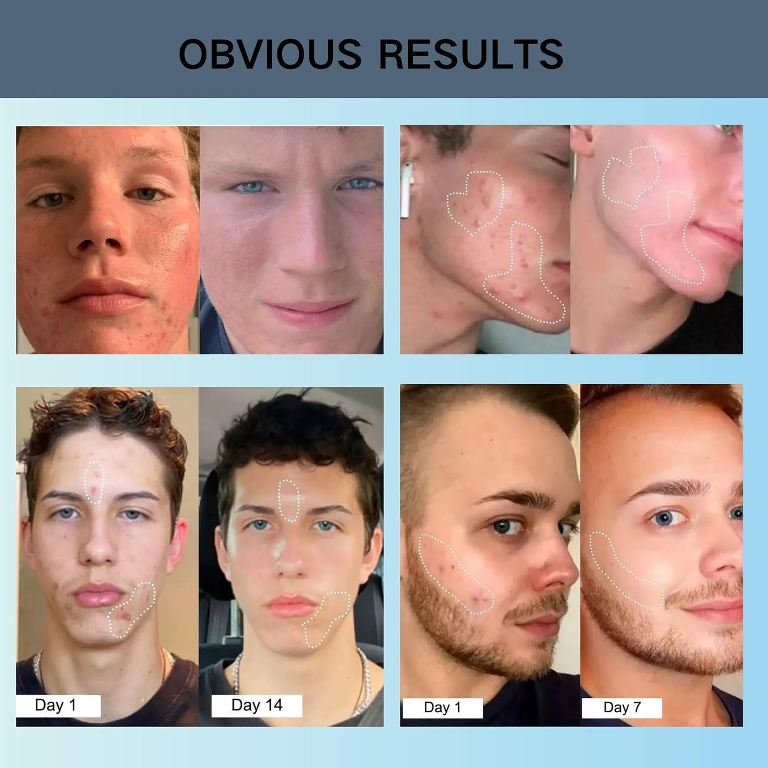 3 Pcs Organics Acne & Redness Killer,Acnes and Redness Relief Balm,Remove Skin Care Set,Ultra-Performance Skincare for Men and Women - Image 4