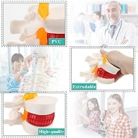 Vista 4 de RONTEN Modelo de hernia de disco lumbar de tamaño real, modelo de hernia de disco lumbar anatómica humana, modelo anatómico de columna lumbar