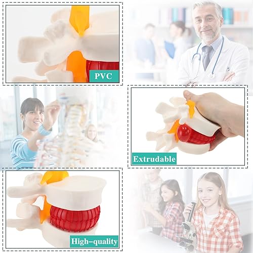 Miniatura 4 de Modelo de hernia de disco lumbar, modelo anatómico de columna lumbar humana para enseñanza médica y aprendizaje