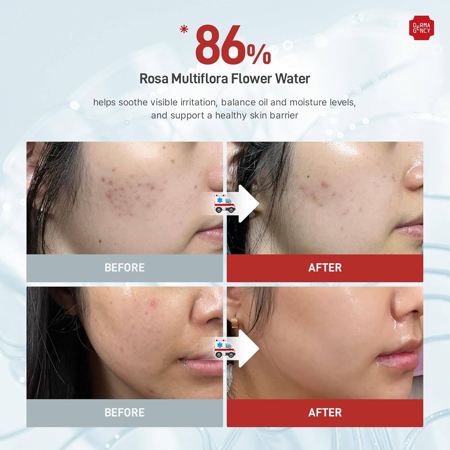 Zeroca 86 Toner - Korean Wild Rose Water for Acne-Prone & Sensitive Skin – Fast Calming & Soothing for Breakout Relief – Calms Redness & Supports Clear Skin,6.76 oz. 200ml - Image 5