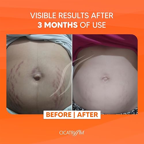 Miniatura 3 de Cicatrissim Crema de estrías para estrías rojas y blancas, suaviza las estrías, unifica el tono de la piel y reafirma la piel, todo