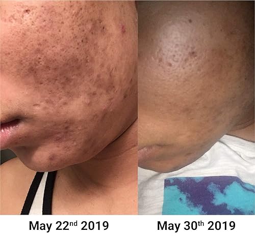 Miniatura 3 de NxN Suero facial de ácido hialurónico hidrata la piel, aumenta el colágeno, reduce las líneas y arrugas - Todo tipo de piel