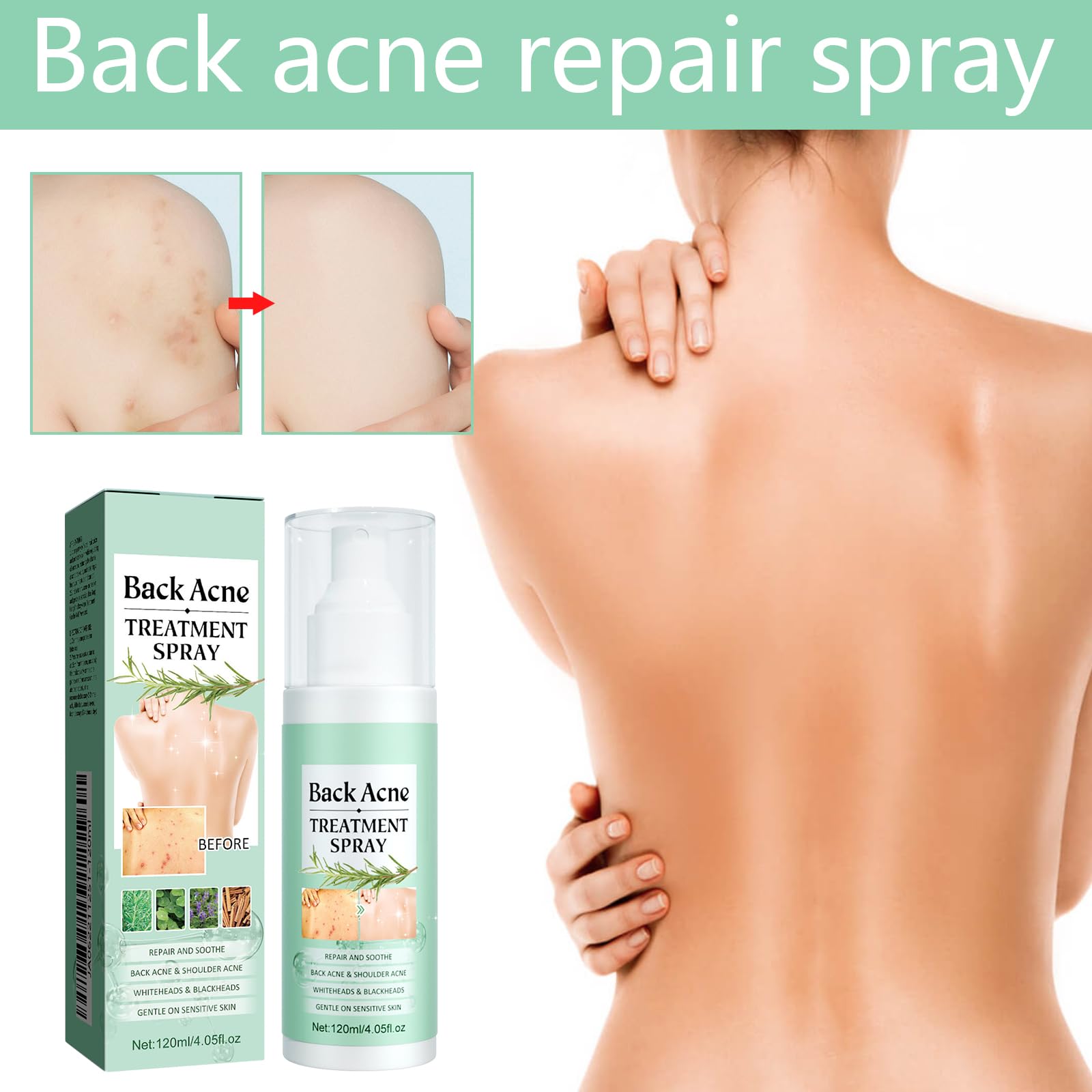 Spray na trądzik na plecach, 2 sztuki spray przeciwtrądzikowy na plecach, przeciw pryszczom i plecom, głębokie oczyszczanie, spray do pielęgnacji ciała, klatki piersiowej i pleców, łagodny dla skóry