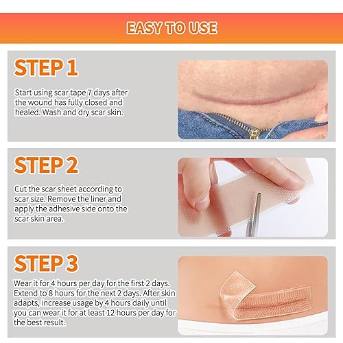 Miniatura 7 de Cinta de silicona para cicatrices (rollo de 1.6 x 59 pulgadas, rollo de 4.9 ft), láminas de silicona de grado médico para cicatrices quirúrgicas,