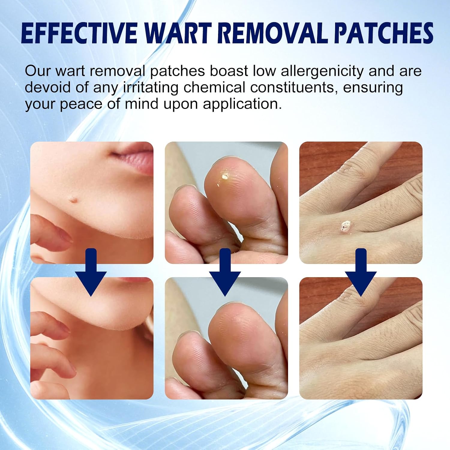 Maximum Strength Salicylic Acid Wart Remover Patches, 180 Count, Hydrocolloid Waterproof Invisible Stickers, Easy-to-Use Targeted Care for Plantar and Common Warts-180Count-1 Pack