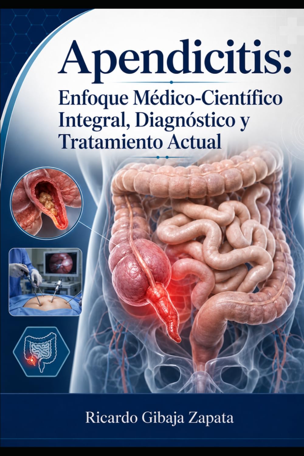 Apendicitis: Enfoque Médico-Científico Integral, Diagnóstico y Tratamiento Actual