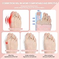 Vista 2 de Corrector de juanetes para mujeres y hombres, 2 piezas, férula de juanete para hallux valgus/alivio del dolor del dedo gordo/enderezador ortopédico
