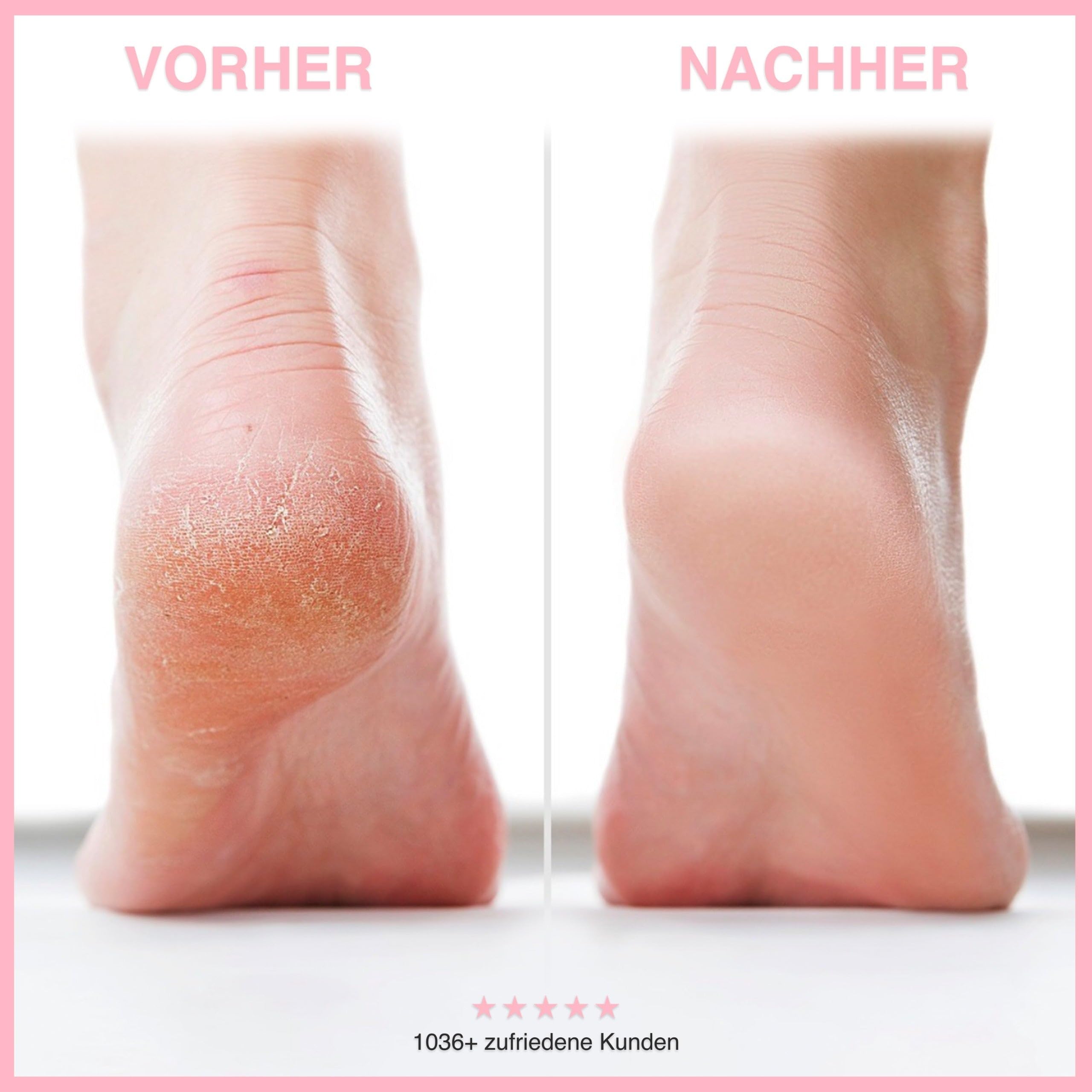 Footglow Hornhautentferner, Elektrischer Hornhautentferner Fußpflegegerät Pediküre, Hornhautentferner Elektrisch, Foot glow Maschine, Footgloworiginal effektiver Callus Remover